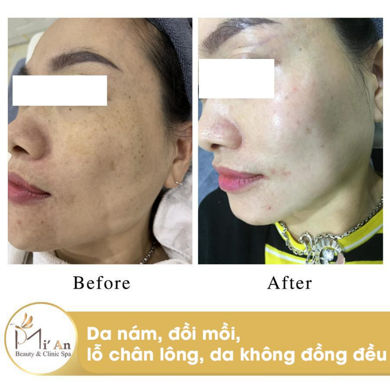 Mi'An Beauty & Clinic Spa địa chỉ điều trị nám tốt nhất tại Pleiku, Gia Lai